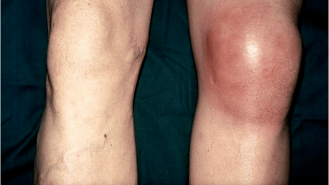 Osteoarthritis and arthritis