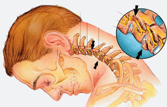 Stages of the osteochondrosis of the cervical column